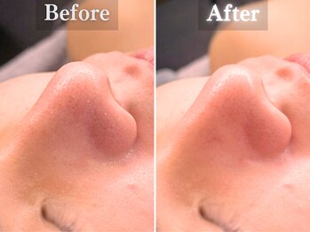 ボーンオム(Born Homme)/毛穴洗浄＋美容液導入：20代女性