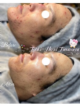 ラティーナ(Lattina)/赤ニキビ　ハーブピーリング