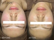 Velisse 表参道店【ヴェリス】《毛穴/肌質改善/ハーブピーリング/ニキビケア》/