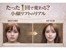 【5名様限定】韓国で話題MWプロ小顔(顔+顎下)1回￥12,100