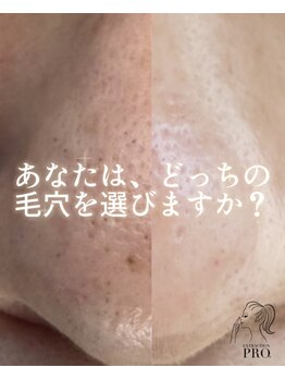 サロン エルピナ(salon ELPINA)の写真/毛穴の黒ずみ・角栓・ザラつきを専用技術で丁寧にケア。取るだけではなく、引き締めることで毛穴悩み卒業♪