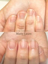 マリーロール 梅田店(Marie Laure)/自爪育成/深爪矯正/ネイルケア