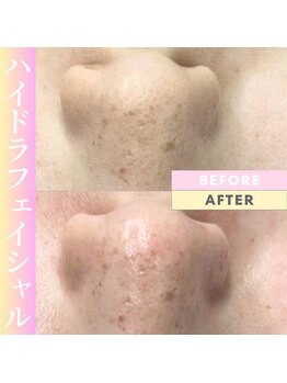 Cスキンケアクリニック 麻布店/毛穴洗浄ハイドラフェイシャル
