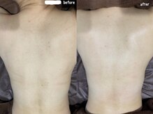 フルール(Fleur)/■背中トリートメント■