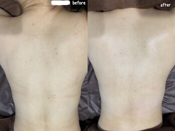 フルール(Fleur)/■背中トリートメント■