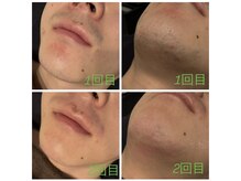 サンデートータルビューティーサロンニイガタ(Sunday Total Beauty Salon niigata)/ひげ脱毛