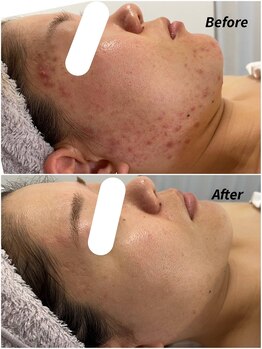 ラヴィアンローズ 蒲郡店(& La vie en Rose)/イロンハーブピーリング