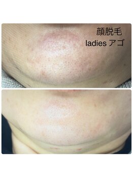 エヌアール(NR)/ladies 顔脱毛