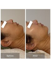 ココ(COCO)/ハーブピーリング/REVI/高知