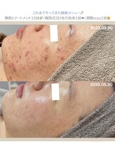 クレヴィー(Creviy)/何してもダメだったニキビケアに