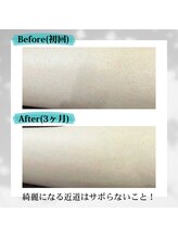 ナンバーフォー 池尻大橋(No.4)/全身脱毛/写真はスネ