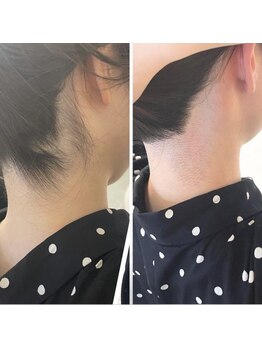 ミース 久留米店/うなじ脱毛体験1回目！