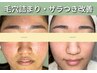 【毛穴・ザラつき/本気改善】★2回目★肌トラブル特化◎￥14300→