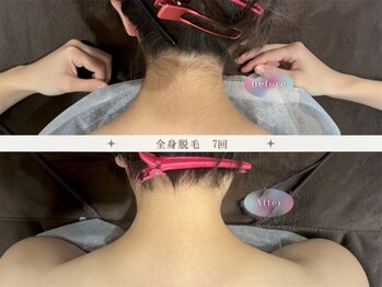 モアトゥインクル 福山神辺店(MORE twinkle)の写真/自分では自己処理が難しい背面はプロにお任せ下さい★ブライダルにもおススメです★