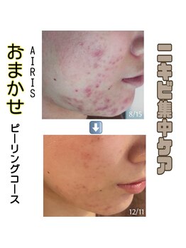 アイリス(AIRIS)/ニキビケア/肌荒れ改善/乾燥