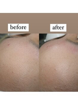 テンパ ビューティー(+10%beauty)/一撃タマゴ肌ワックス