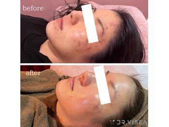 アンベリール(embellir.)/本気のニキビケア