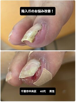 陥入爪の悩みに対して改善を実感