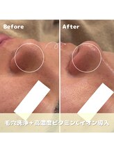 クレア(Clair)/毛穴洗浄