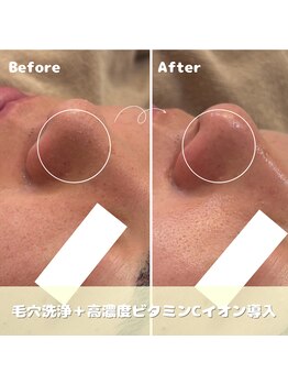 クレア(Clair)/毛穴洗浄