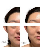 マヌレニ(manuleni)/目の下クマ脂肪とらずにスッキリ