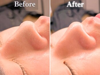 ボーンオム(Born Homme)/毛穴洗浄＋美容液導入：30代男性