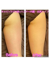 アンジュエール(Angeaile)/太もも徹底ケア