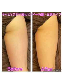 アンジュエール(Angeaile)/太もも徹底ケア