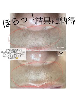 プラスエム(+M)/毛穴の黒ずみ