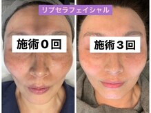 プリュネル(Prunelle)/プラズマシャワー