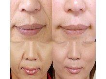 ナチュレアンドメディカ(Nature&Medica)/【小顔】ソフウェーブ