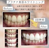 ホワイトニングプラス(Whitening+)