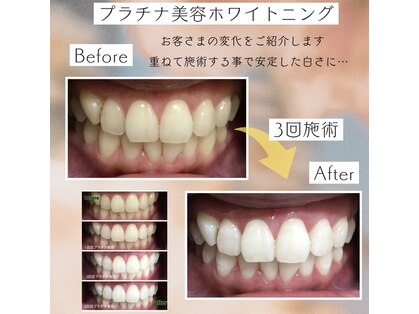 ホワイトニングプラス(Whitening+)の写真