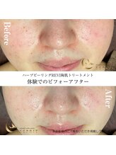 エスプリ 新宿店/ハーブピーリングルビ新宿