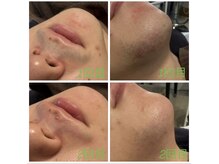 サンデートータルビューティーサロンニイガタ(Sunday Total Beauty Salon niigata)/ひげ脱毛