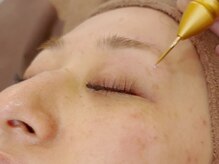 アース 脱毛＆Eyelash 土気あすみが丘店(EARTH)の雰囲気（千葉エリアで1台しかないシミケアで肌質改善しましょう！）