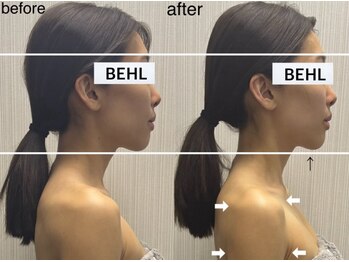 ベール(BEHL)/コルギのBefore After