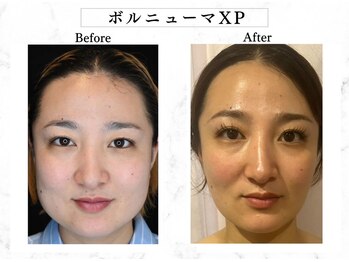 モテ美白/ボルニューマで小顔に!