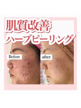 ホワイトアクア 加古川店(WHITE AQUA)/ハーブピーリング/兵庫/加古川