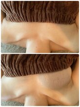 スマイルクルー(SmileClue)/初回ビフォーアフター症例