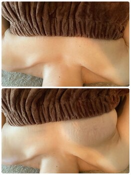 スマイルクルー(SmileClue)/初回ビフォーアフター症例