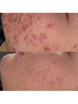 ソアン(Soin)/ハーブピーリング