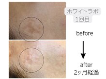 サロン リノ(salon rino)の雰囲気（1回でもシミここまで反応◎ホワイトラボ気になるシミを狙いうち）