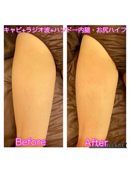 アンジュエール(Angeaile)/太もも徹底ケア