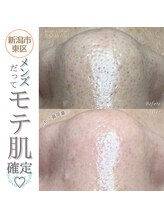 ソマリ(SOMALI)/【毛穴洗浄＆ヒト幹導入】