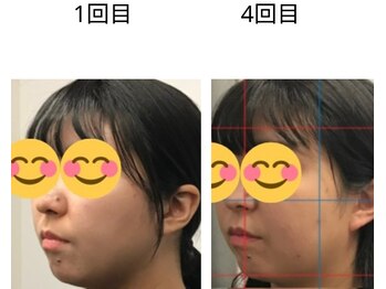 ベル/20代の方の小顔Before After