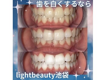 ライトビューティー 池袋店(LightBeauty)/症例写真