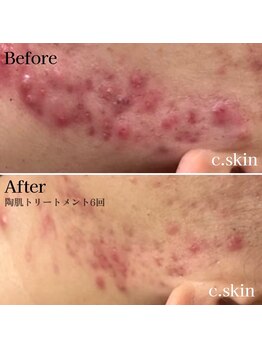 シースキン 盛岡駅前店(c.skin)/お客様ビフォーアフター