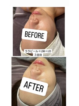 バブルビューティー(Bubble beauty)/ララピール・LDM・LED