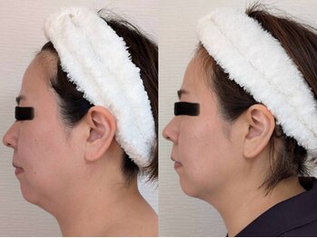 レゾン 京橋店/最新！韓国美容☆レモンボトル